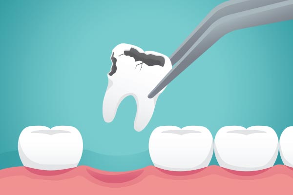 Ask a General Dentist: What Happens to Your Tooth After Extraction from Best Smile 4 All in Plantation, FL