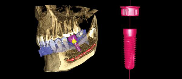 Dental implant