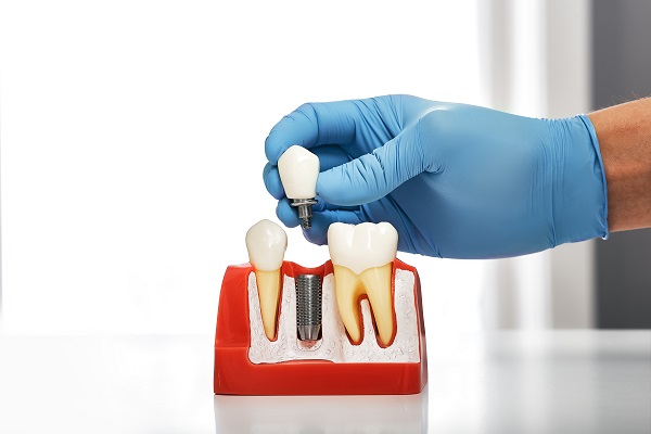 The Success Rate Of Dental Implant Restoration