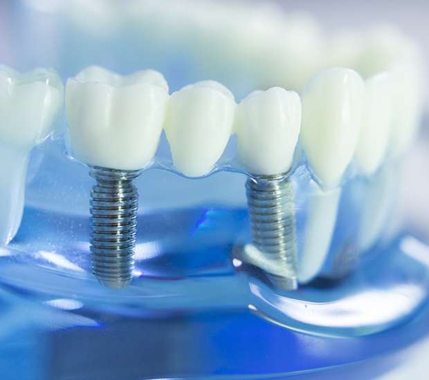Plantation Dental Implants